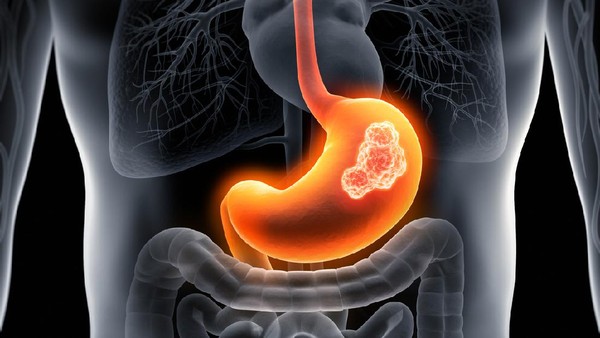 Cegah Asam Lambung Saat Berpuasa dengan menjaga Pola Makan